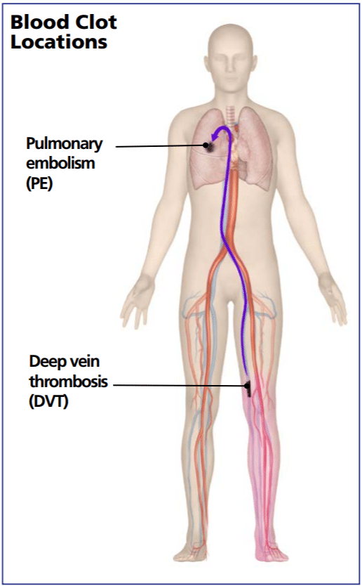 Avoiding blood clots